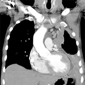 CT of chest in patient with left sided Mesothelioma
